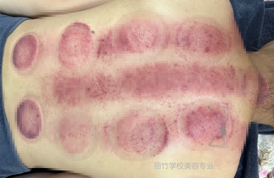 拔火罐的顏色代表什么？南寧美容美體專業(yè)實(shí)訓(xùn)