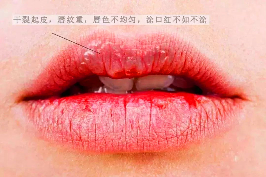 廣西皮膚管理培訓(xùn)機構(gòu)：解決嘴唇干裂的急救方法