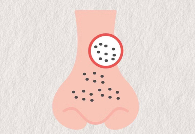 廣西皮膚管理師：面對嚴重的黑頭應該怎么辦？